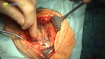 Ligadura da veia facial, transecção parcial do músculo digástrico