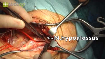Preparação da ACE e ACI, Mobilização do Nervo Hipoglosso