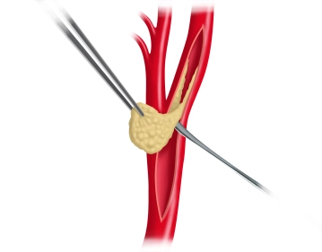 Pinçamento da Bifurcação Carotídea e TEA