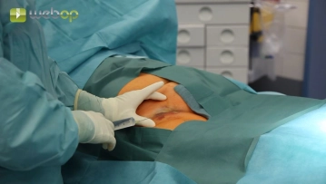 Punção da artéria femoral comum direita