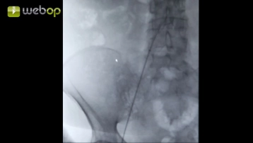 Avançando a bainha até o arco aórtico