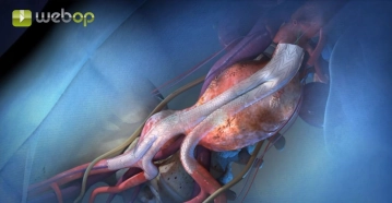 Princípio do Procedimento Endovascular