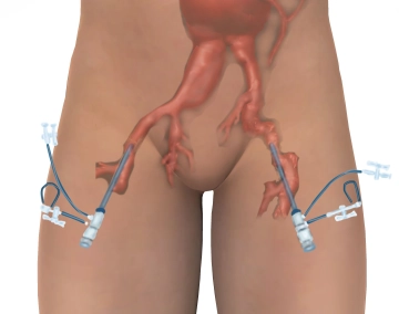 Acesso inguinal bilateral