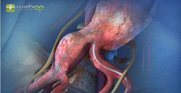 Inserção e Pré-posicionamento do Componente de Ramo Ilíaco