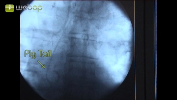 Colocação de um Cateter Pigtail