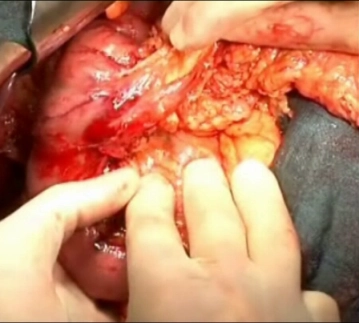 Palpação da Cabeça do Pâncreas