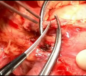 Ligadura da Artéria Gástrica Direita