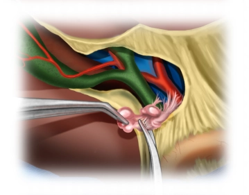 Visualização do Ligamentum hepatoduodenale com linfadenectomia extra-hepática completa
