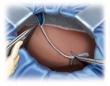 Transecção do ligamento falciforme do fígado