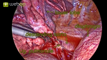 Dissecção do ligamento pulmonar