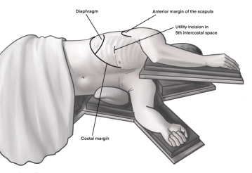 Uniportal VATS direito