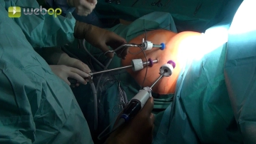 Colocação de acessos para timectomia VATS