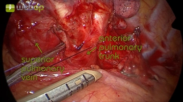 Dissecção do tronco anterior da artéria pulmonar