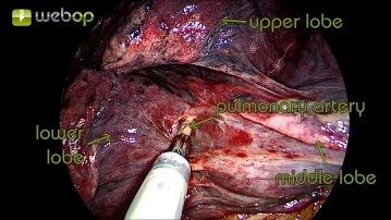Visualização da artéria pulmonar