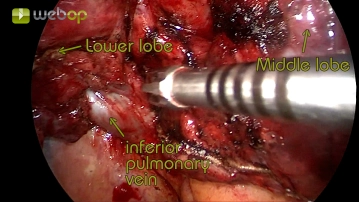 Preparação do ligamento pulmonar e visualização da veia pulmonar inferior