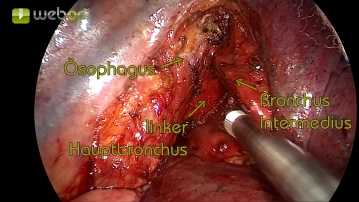 Ressecção em bloco dos linfonodos da estação 7 (de acordo com IALSC)