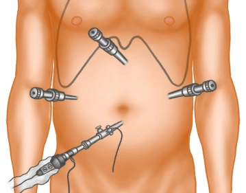 Posicionamento dos Trocateres