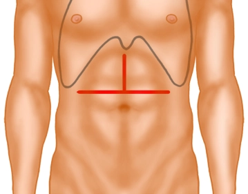 Laparotomia Transversa Abdominal Superior