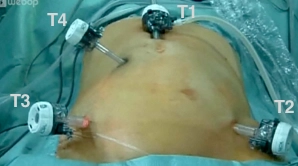 Criação de pneumoperitônio / Colocação de trocartes de trabalho