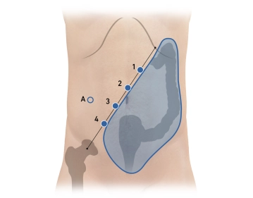 Posicionamento do trocater e acoplamento