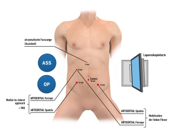 Criação do Capnoperitônio e Posicionamento dos Trocares