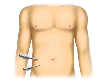 Inserção da ótica e dos trocartes de trabalho