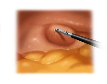 Inspeção do orifício da hérnia