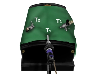 Colocación de trócares