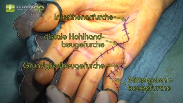 Planejamento/Incisão