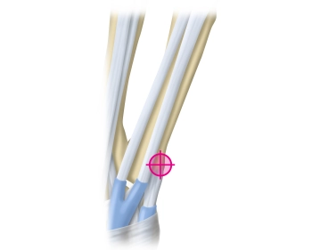 Planejamento/Incisão