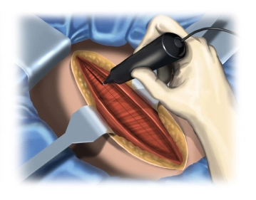 Transección de la pared abdominal