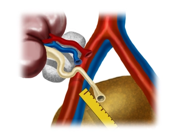 Preparación del riñón donante / Posicionamiento de prueba
