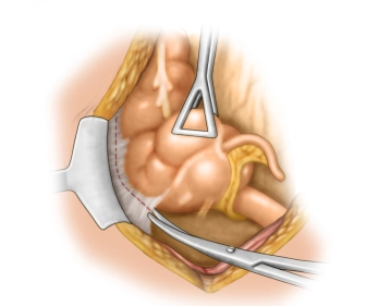 Mobilização do cólon ascendente