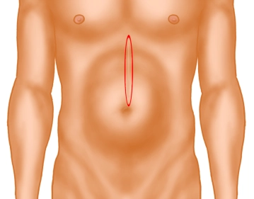 Excisição da cicatriz da pele