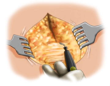 Exposição do defeito fascial