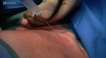 Infiltração da Área Cirúrgica com Anestésico Local