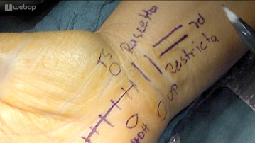 Planejamento/Incisão na Pele 2