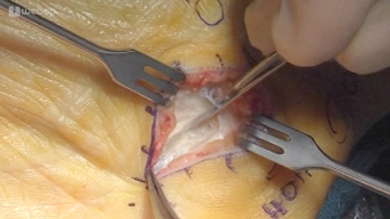 Transecção da Aponeurose Palmar 2