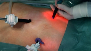 Colocación de los trocares