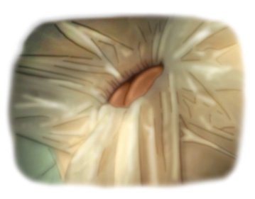 Retração das bordas da pele