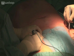 Exposição dos vasos inguinais bilateralmente