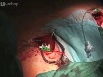 Inserção de Bainhas