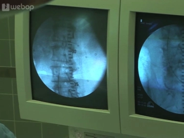 Colocação do fio-guia rígido (pela esquerda)