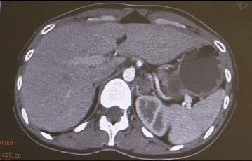 Hallazgo tomográfico computarizado