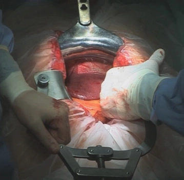 Laparotomia e Exploração