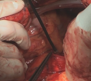 Mobilização Duodenal