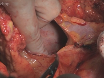 Abertura da bolsa omental