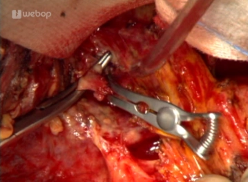 Preparación y sección de la vena porta