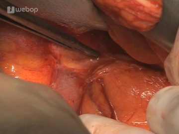 Mobilização do cólon descendente e cólon sigmoide