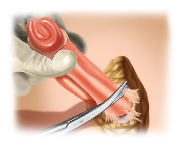 Mobilização e Preparação na Fáscia